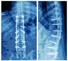 症例②「腰痛・脊柱管狭窄症などの手術の後遺症」